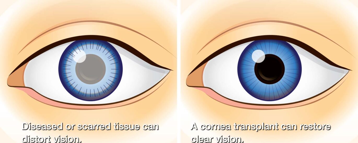 Corneal Transplant