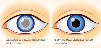 Corneal Transplant