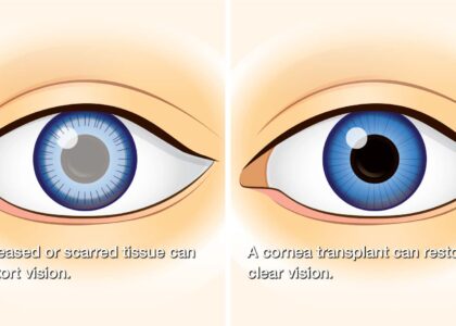 Corneal Transplant